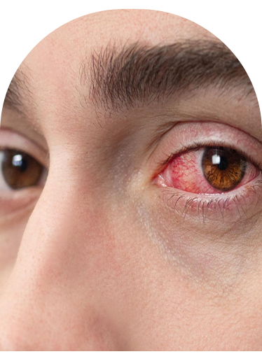 man needing to cure for red eyes